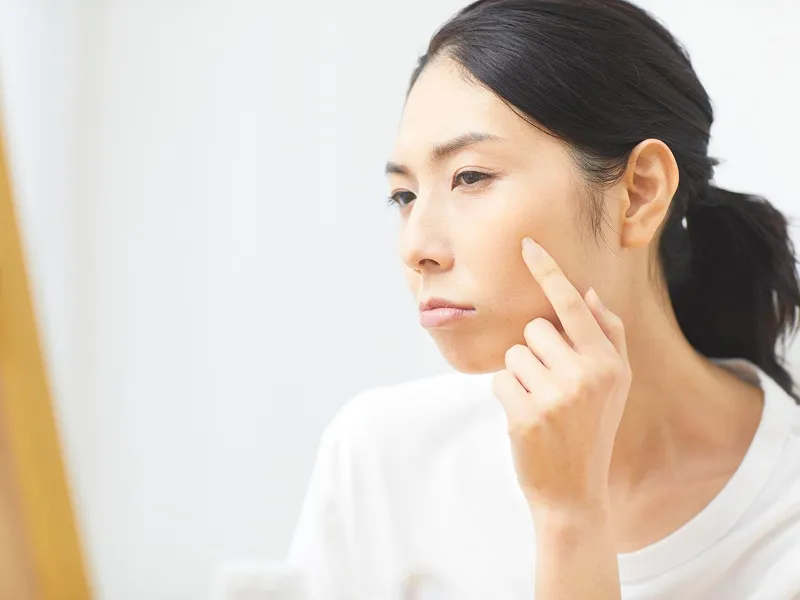 荒れ症に悩む女性